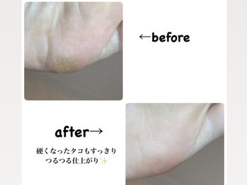 【魚の目/タコ】20代女性