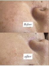 レシェルサロン(Lechelle Salon)/ダクトピーリング