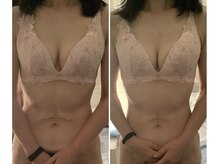 ブレスト 新宿本店(Breast)/《10回施術》40代(バストアップ)