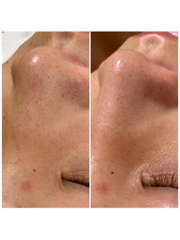 ソラ(sora)/ハイドロ・毛穴の症例★