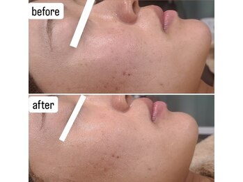 シス(SiS.)/ハーブピーリング一回目