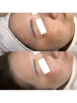 ホワイトワックス 京都四条烏丸(WHITE WAX)/お肌も生え際もスッキリ◎