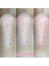 アモリアージュ(Amolliage)/韓国式3D毛穴洗浄