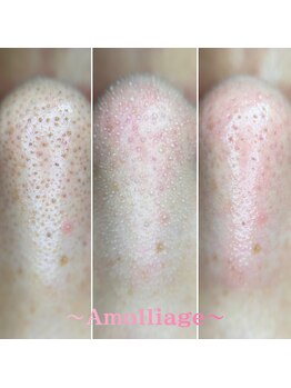 アモリアージュ(Amolliage)/韓国式3D毛穴洗浄