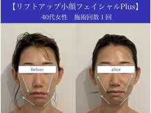 リプロ(RePro)の雰囲気（施術中から感じる引き上がりに感動☆デコルテ頭皮まで引き上げ！）
