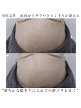 ヴェルシック(Belchic)/ザラつきと毛穴汚れ分解