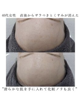 ヴェルシック(Belchic)/ザラつきと毛穴汚れ分解