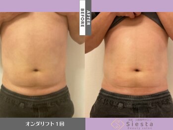 シエスタ(siesta)/韓国脂肪分解リフト ボディー