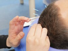 あおぞら整骨院 二俣川院の雰囲気(肩や腰のほか脳天の鍼や美容鍼といった鍼メニューもございます。)