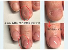 クウ(KUU)/深爪予防ケアが重要