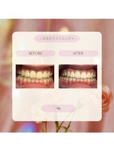 プラスビー 2号店(+b)/ホワイトニングビフォーアフター