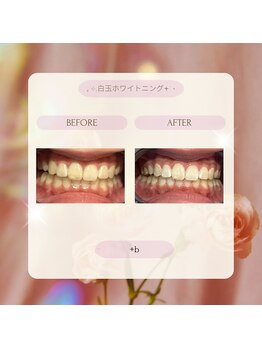 プラスビー 2号店(+b)/ホワイトニングビフォーアフター
