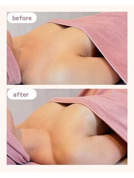 ワム(Wom)/30代/バストアップ施術8回目