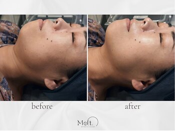 メルト 中目黒(Melt.)/◇サーマジェン