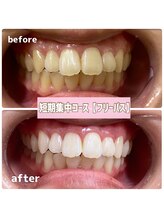 ビーホワイト 名古屋金山店(BE WHITE)/ ホワイトニング★ブライダル