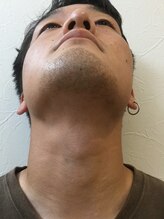 ディークロス(D cross)/メンズヒゲ脱毛