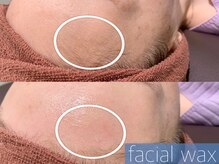 レーヴ(REVE)/フェイシャルワックス（生え際）