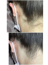 グロー(GLOW)/うなじ脱毛