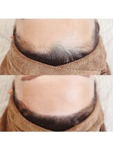 ブルーモ(Bloomo)/Before After［おでこ］