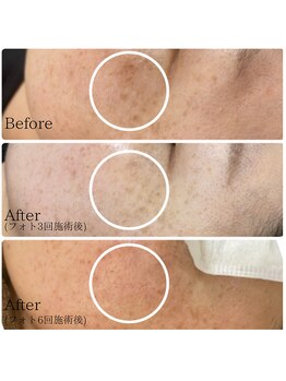 エース(ACE.)/光フェイシャル☆