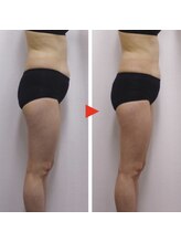 プレジール(PLAISIR)/キャビテーション腹部・ウエスト