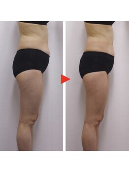 プレジール(PLAISIR)/キャビテーション腹部・ウエスト