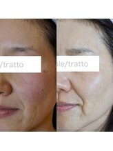 トラット エステアンドアイズ(tratto)/50代　お客様症例写真