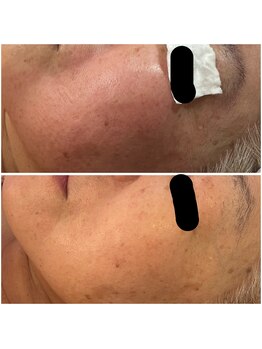 ルーラ(LURA)/肌を総入れ替え！リボーニング