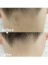 メゾン ド クロエ(Maison de Chloe)/ブライダルシェービング