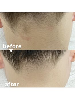 メゾン ド クロエ(Maison de Chloe)/ブライダルシェービング