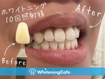 ホワイトニングカフェ 宇都宮店/◎歯のホワイトニング施術写真◎