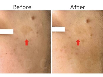 ココロ(COCORO)/シミケアが得意なプラズマ