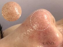 キャンディ 岐阜(CANDi)/ハイドラピーリング/黒ずみ毛穴