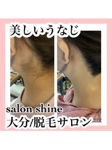 サロンシャイン(Salon Shine)/うなじ脱毛２０代前半女性