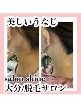 サロンシャイン(Salon Shine)/うなじ脱毛２０代前半女性