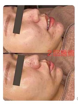 ホワイトアクア 福岡天神店(WHITE AQUA)/ララピールでニキビケア/天神