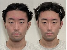 小顔22 ボルティ 本店(Bolty)/小顔矯正初回