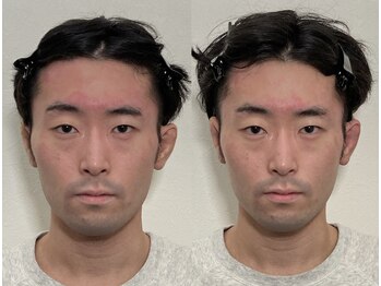 小顔22 ボルティ 本店(Bolty)/小顔矯正初回