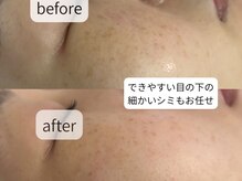 サロン ドロップ 上小田井(Salon drop)/「シミ改善」