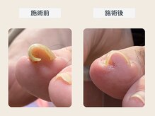 ルポ 伊勢/巻き爪ケア