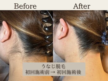 インベスト(INVEST)/うなじ脱毛