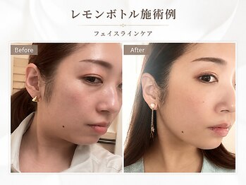 ルアナ/レモンボトル小顔ケア