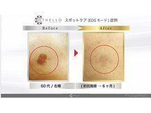 クリニカルエステ花蔵 熊谷駅前店/【シミ改善体験コ-ス】Step1.