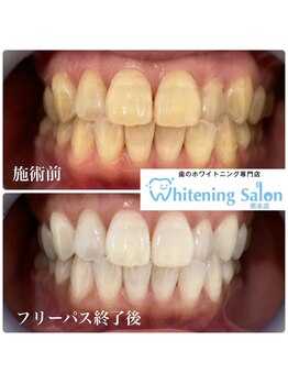 ホワイトニングサロン 熊本店/【ホワイトニング施術例】