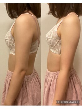 アネラ 京都駅前店(Anela)/【姿勢改善】Before & After