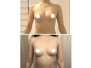 デミーナ(Demyna)/【バストアップ】症例 育乳