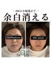 【４回小顔モニター様限定】小顔矯正+美肌美顔器＋オイルケア¥83,600→32,000