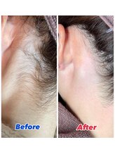 エステサロン桜/うなじワックス脱毛