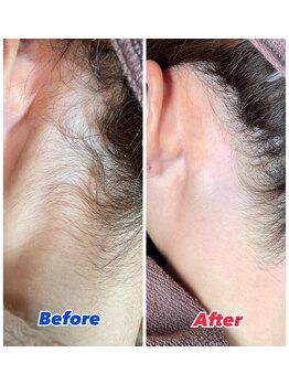 エステサロン桜/うなじワックス脱毛