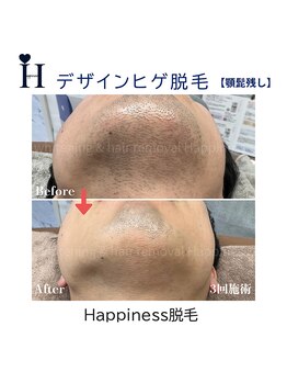 ハピネス 岡山店(Happiness)/顎残し